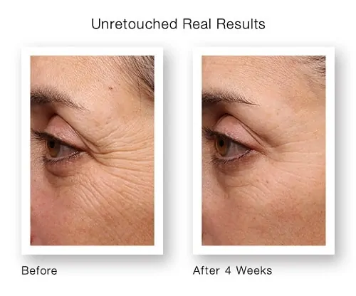 Op deze foto is een vrouw te zien met voor en na resultaten van fijne lijntjes bij de ogen. Zij wordt behandeld met retinol serum.