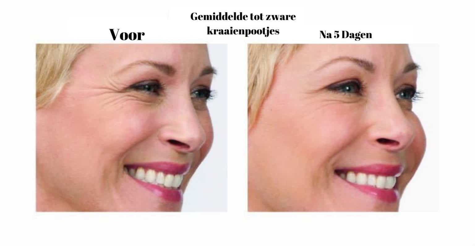 Wenkbrauwlift Fillers Kopen Hyaluronzuur Fillers 1 + 1 Gratis