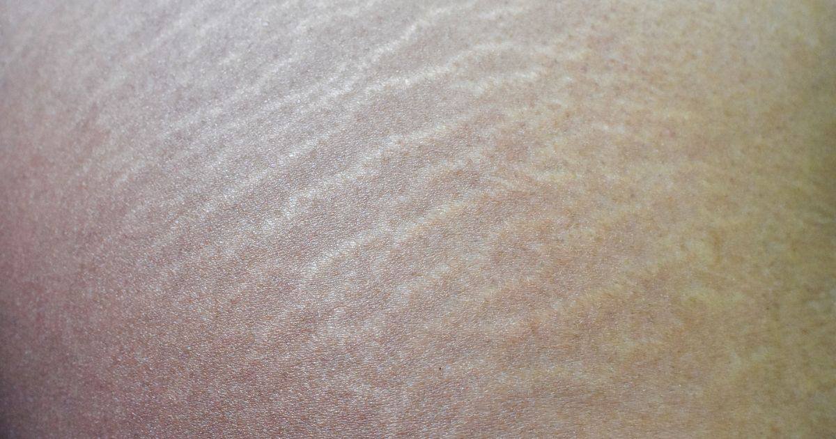 Zwangerschapsstriem - Zwangerschap Striae, huidstriemen, groeistrepen, stretch marks