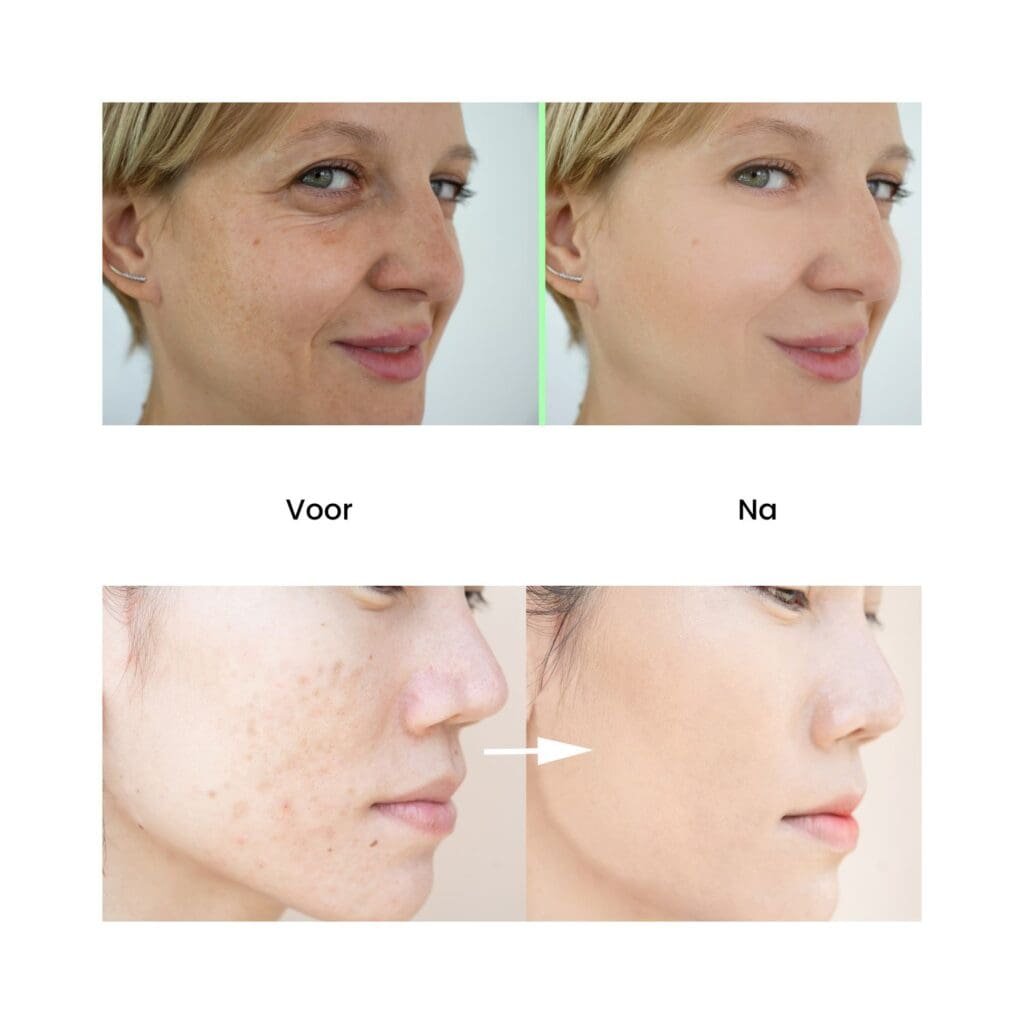 huid serum resultaat voor en na, retinol, huidverzorging, vitamine A serum, wat is een retinol serum? wat doet het voor de huid?, retinol serum tegen rimpels, vitamine a zuur, hoe retinol serum te gebruiken, retinol serum voor gezicht, anti-aging, nachtserum, gezichtsserum 