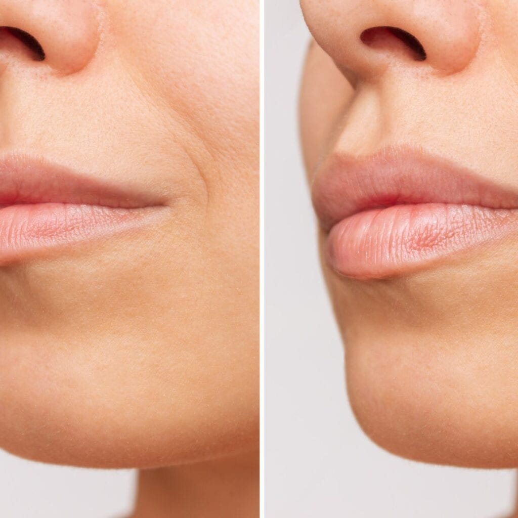 voor en na resultaat volle lippen met hyaluronzuur fillers vollere lippen