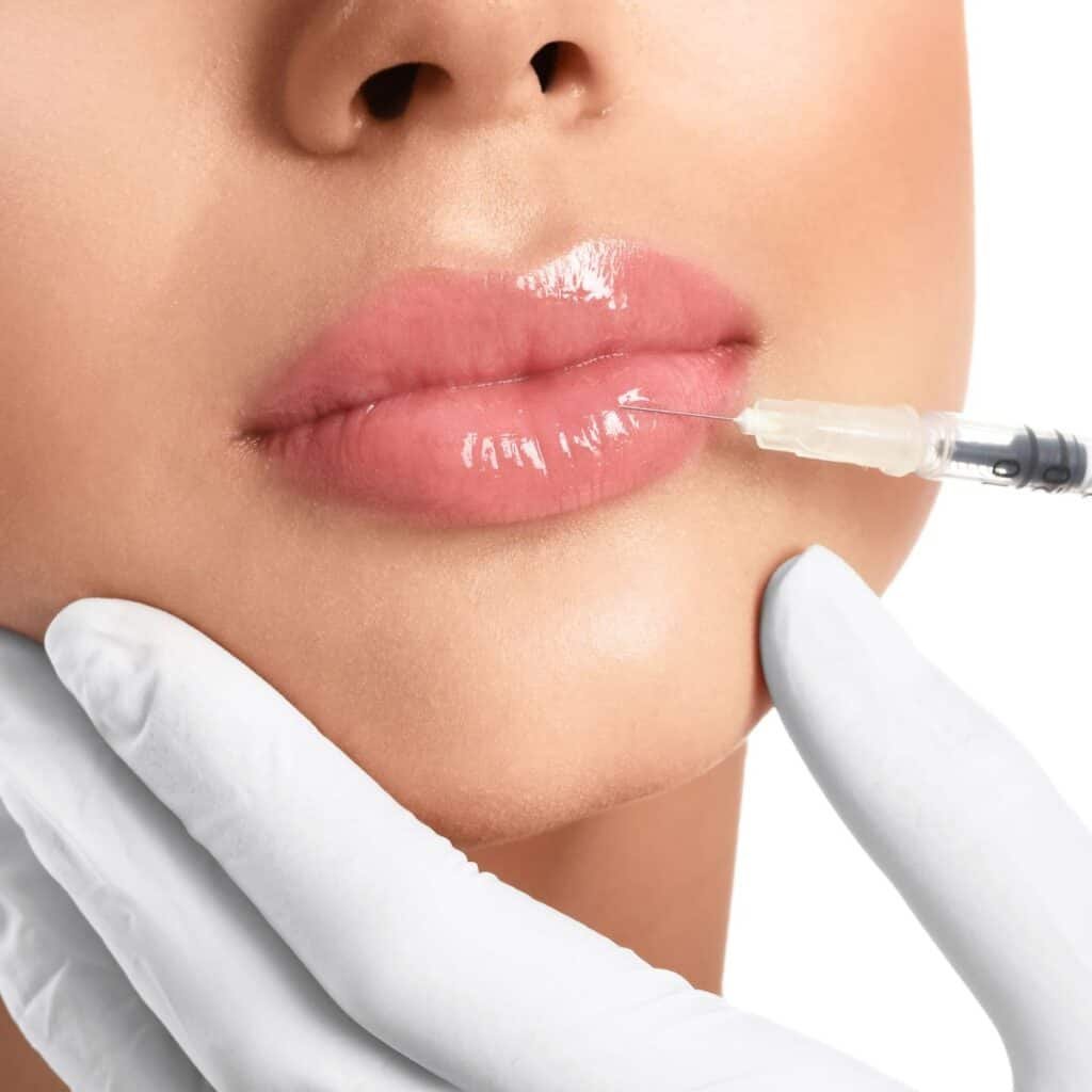 vollere lippen hyaluronzuur fillers 2ml