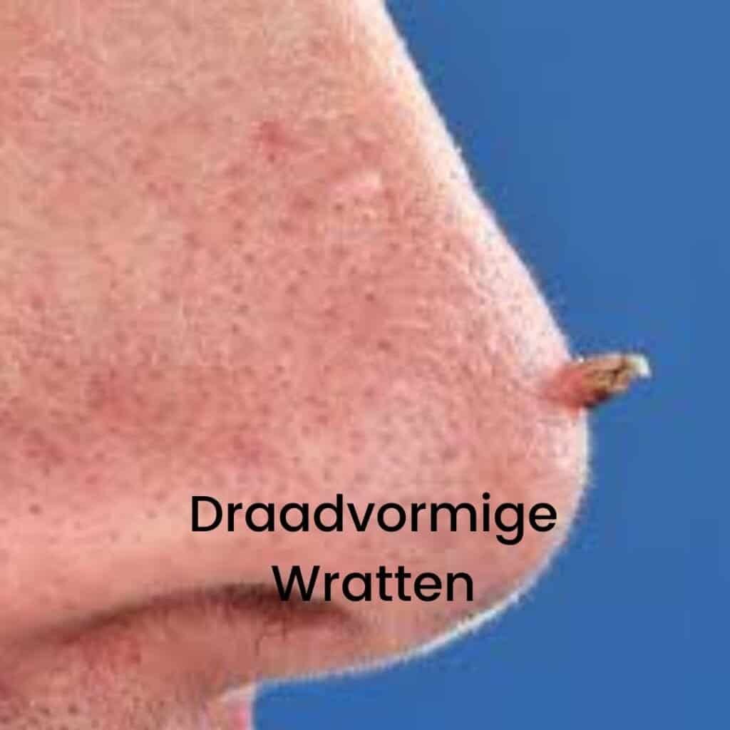 draadvormige wratten, filiforme wratten, wratjes verwijderen, moedervlek verwijderen, laser plasma pen, donkere plekjes, moedervlek zelf verwijderen, ouderdomsvlekken verwijderen