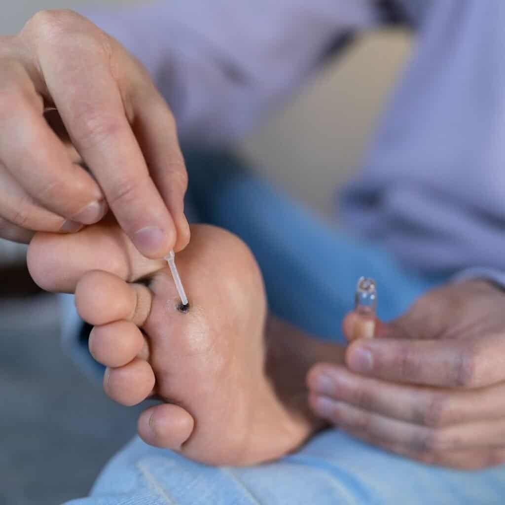 wratten op de voetzool, wratjes verwijderen, moedervlek verwijderen, laser plasma pen, donkere plekjes, moedervlek zelf verwijderen, ouderdomsvlekken verwijderen