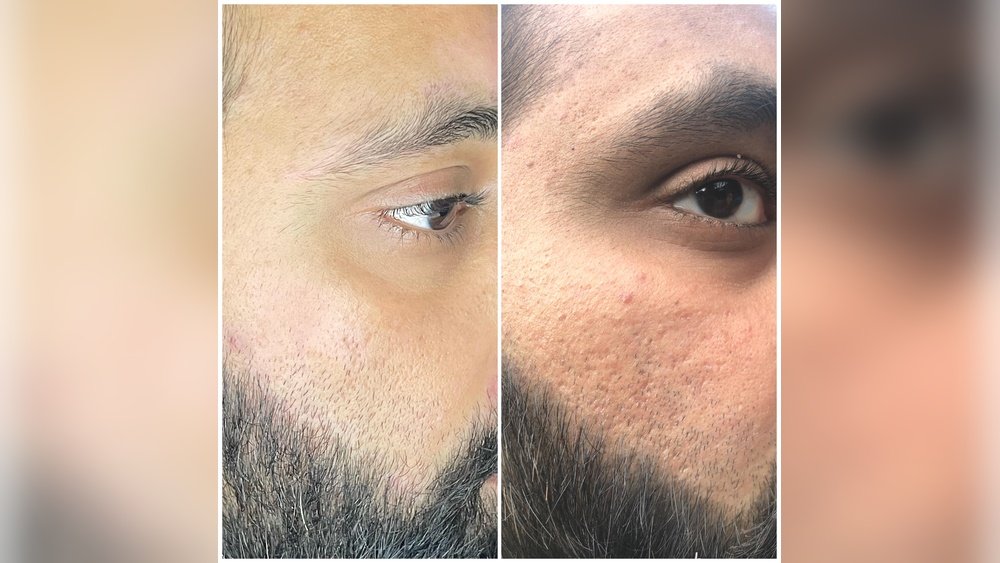 Dermaroller Voor Acnelittekens: Volledige Beginnersgids