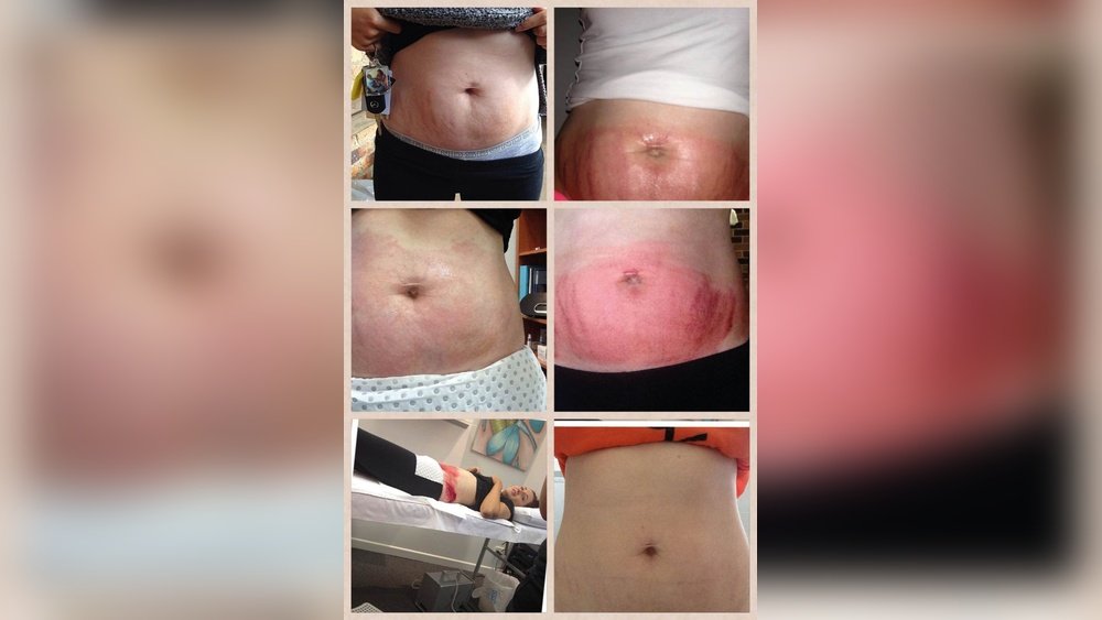 Striae Verwijderen Met Een Dermaroller