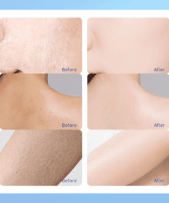 urea crème 40% voor en na afbeelding